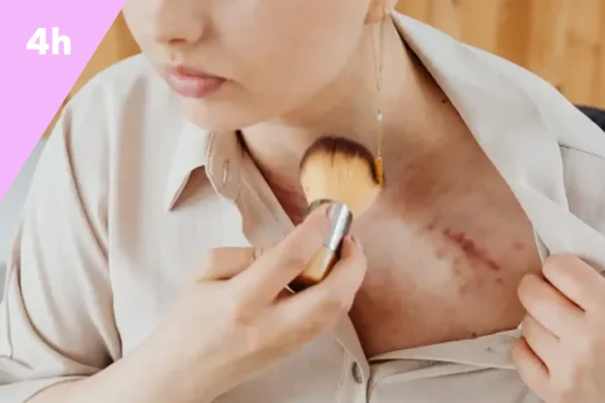 Plaies et processus de cicatrisation essentiel